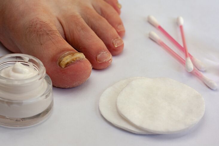 verificați ciuperca unghiilor cu permanganat de potasiu gel pentru tratamentul ciupercilor unghiilor de la picioare